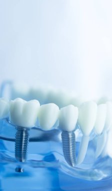 Diş diş diş hekimliği modeli