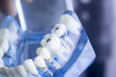 Diş diş diş hekimliği modeli