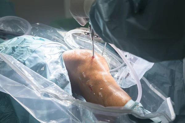 Cirugía de rodilla operación hospitalaria — Foto de Stock