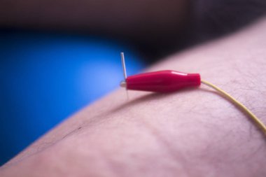 Fizik tedavi acupunture