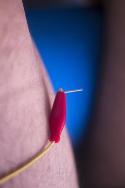 Fizik tedavi acupunture