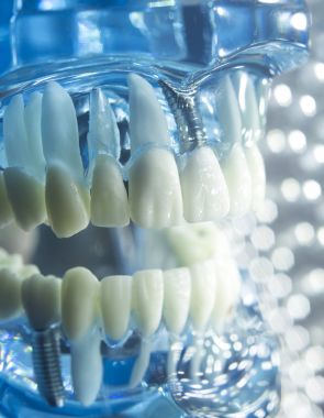 Diş hekimleri diş diş implant