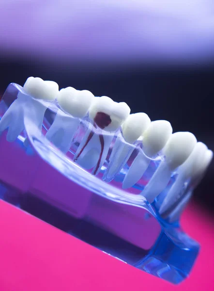 Problema della carie dentale — Foto Stock