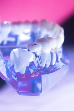 Diş diş kök kanal