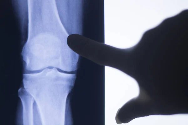 Knee joint xray test scan — Stock Photo, Image