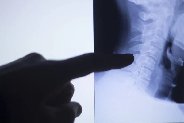 背部脊椎瘫痪 x 射线扫描 — 图库照片