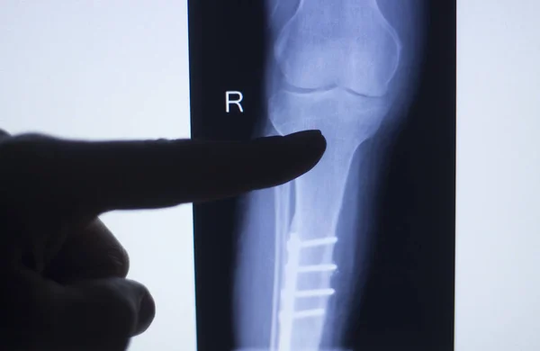 Knie gezamenlijke xray test scan — Stockfoto