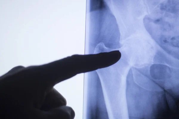 Рентген тазобедренного сустава — стоковое фото