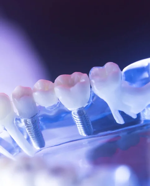 치과 의사 치과 치아 모델 — 스톡 사진