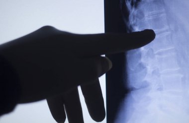 Arka omurga vertabrae xray tarama