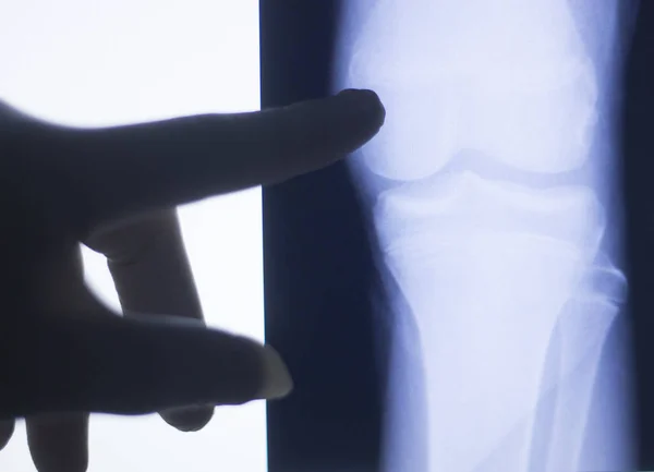 膝盖关节 x 线测试扫描 — 图库照片