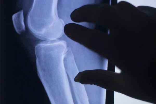 Knee joint xray test scan — Stock Photo, Image