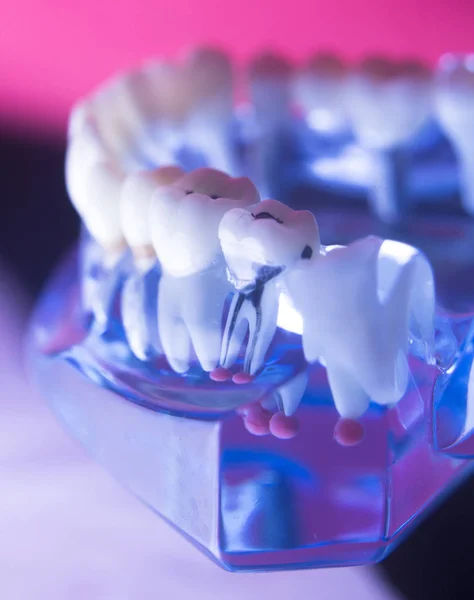 Tandheelkundige tand wortelkanaalbehandeling — Stockfoto