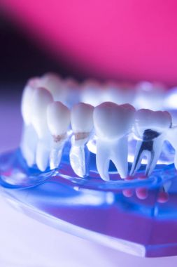 Diş diş kök kanal