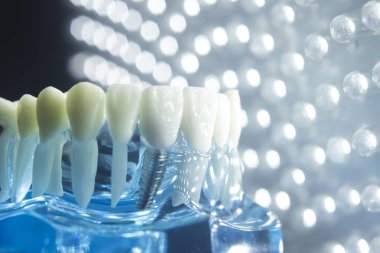 Diş hekimleri diş diş implant