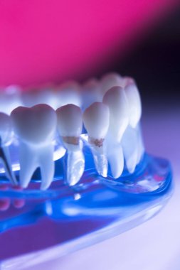 Diş diş kök kanal