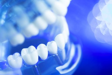 Diş hizalama diş modeli