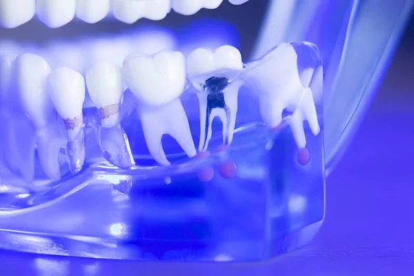 Modelo de dientes de alineación dental — Foto de Stock