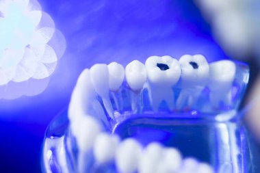 Diş diş çürümesi modeli