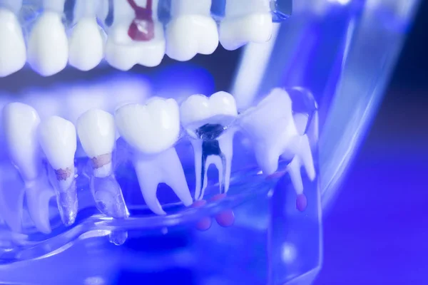 Modelo de dientes de alineación dental — Foto de Stock