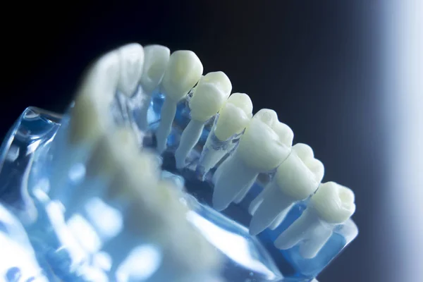 Model próchnicy zębów dentystycznych — Zdjęcie stockowe
