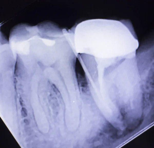 Dente corona canale radicolare — Foto Stock