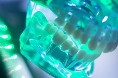 Diş ağız diş modeli