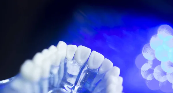 Dental wyrównanie zębów modelu — Zdjęcie stockowe