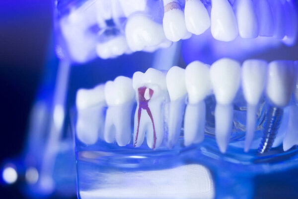 Dental alignment teeth model