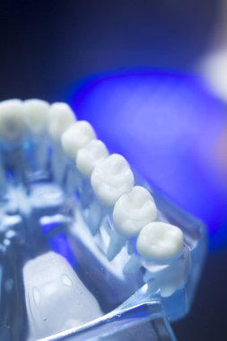 Diş diş çürümesi modeli