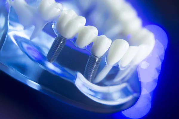 Modelo de caries dental — Foto de Stock