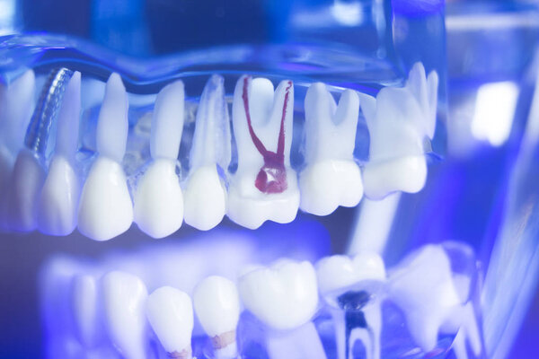 Dental alignment teeth model