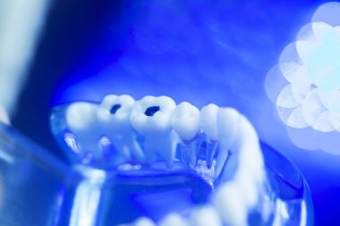 Diş modeli diş çürüğü