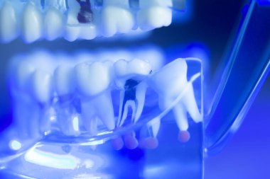 Diş diş kök sinir