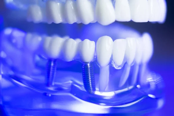 Modelo de dentes de alinhamento dental — Fotografia de Stock