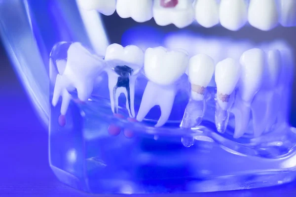Modèle de dents d'alignement dentaire — Photo