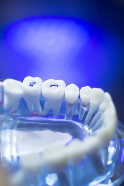 Diş modeli diş çürüğü