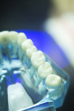 Diş diş çürümesi modeli