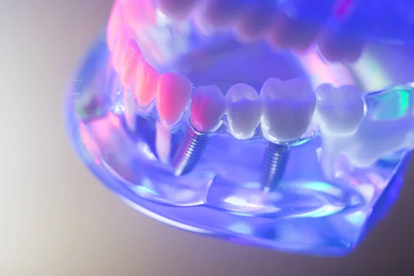 Implantes dentales sanos —  Fotos de Stock