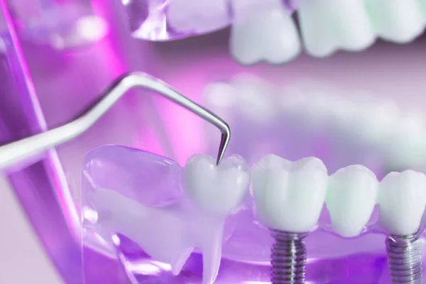 Dentes dentários modelo dentista — Fotografia de Stock