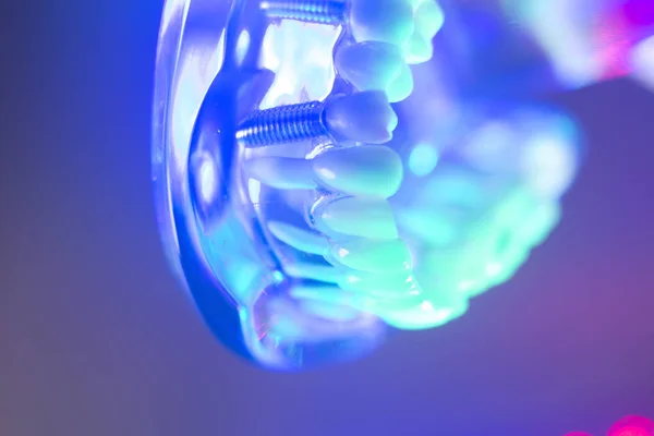 Modelo de ortodoncia dental — Foto de Stock