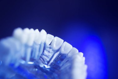 Diş diş çürümesi modeli