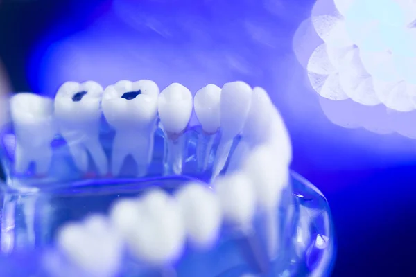 Modelo dentário cárie dentária — Fotografia de Stock