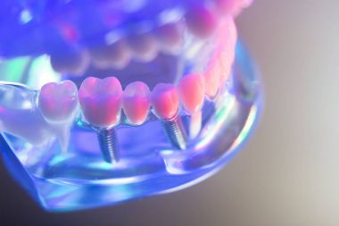 Diş sağlıklı Diş implantları