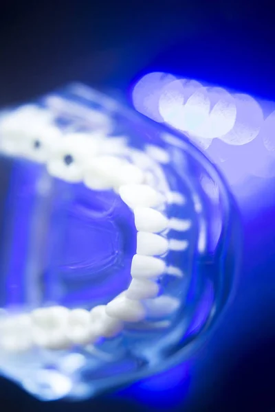 Modelo dental caries dental —  Fotos de Stock
