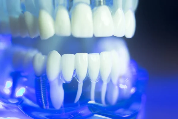 Dental alignment teeth model — Stock Photo, Image