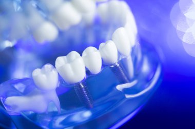 Diş hizalama diş modeli