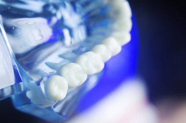 Diş diş çürümesi modeli