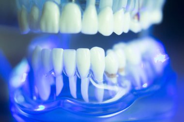 Diş hizalama diş modeli