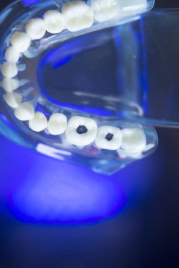 Diş modeli diş çürüğü